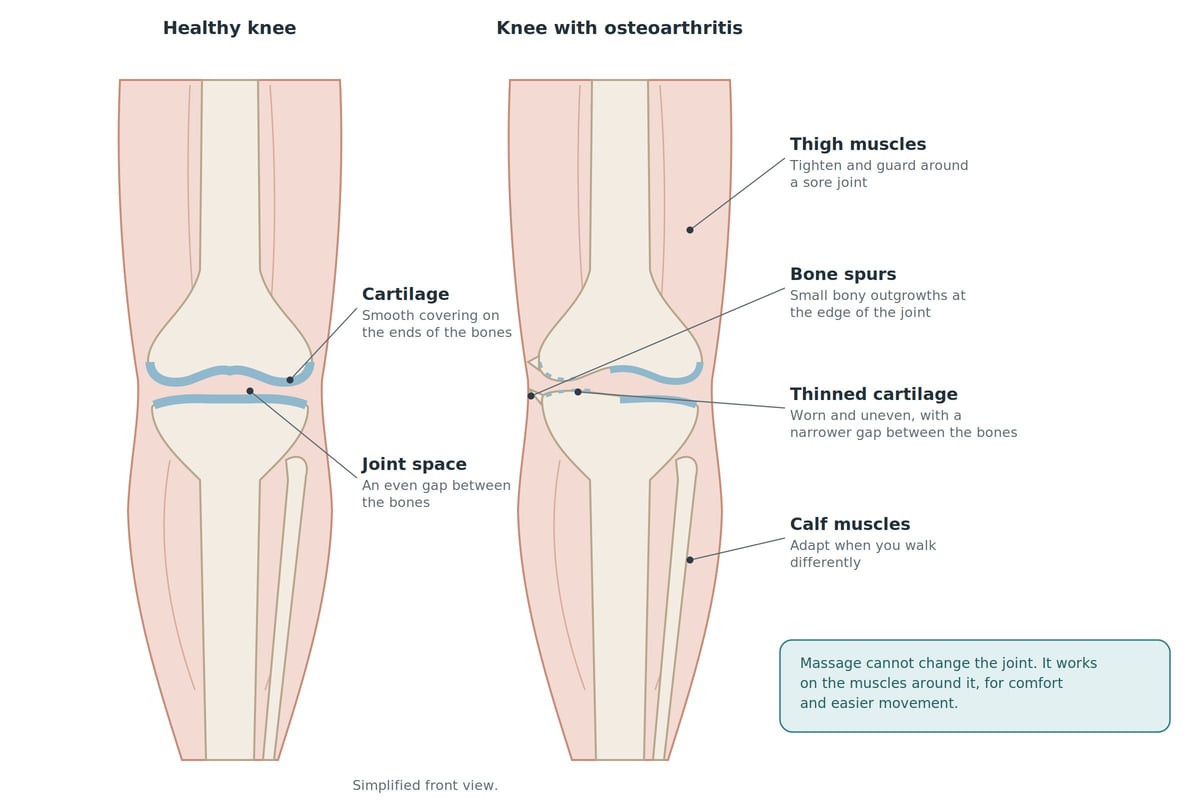 Diagram comparing a healthy knee and an osteoarthritic knee, showing cartilage, joint space, bone spurs, thigh and calf muscles