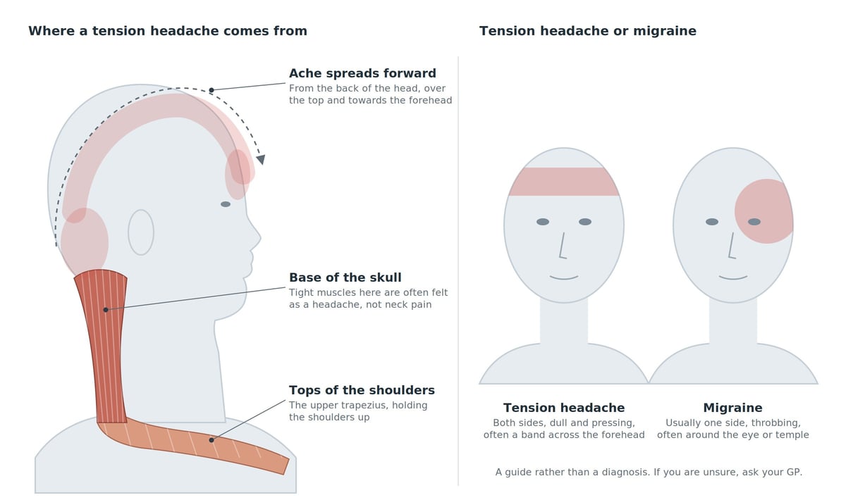 Diagram showing tension headache and migraine sources, with aching areas marked on a head and symptoms compared across two face illustrations