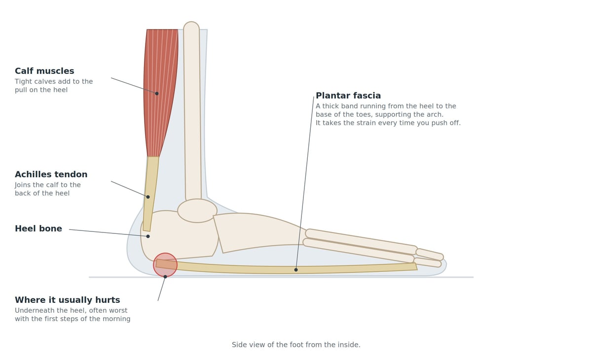 Anatomical diagram of the foot showing the calf muscles, Achilles tendon, heel bone, plantar fascia, and the common pain area of plantar fasciitis