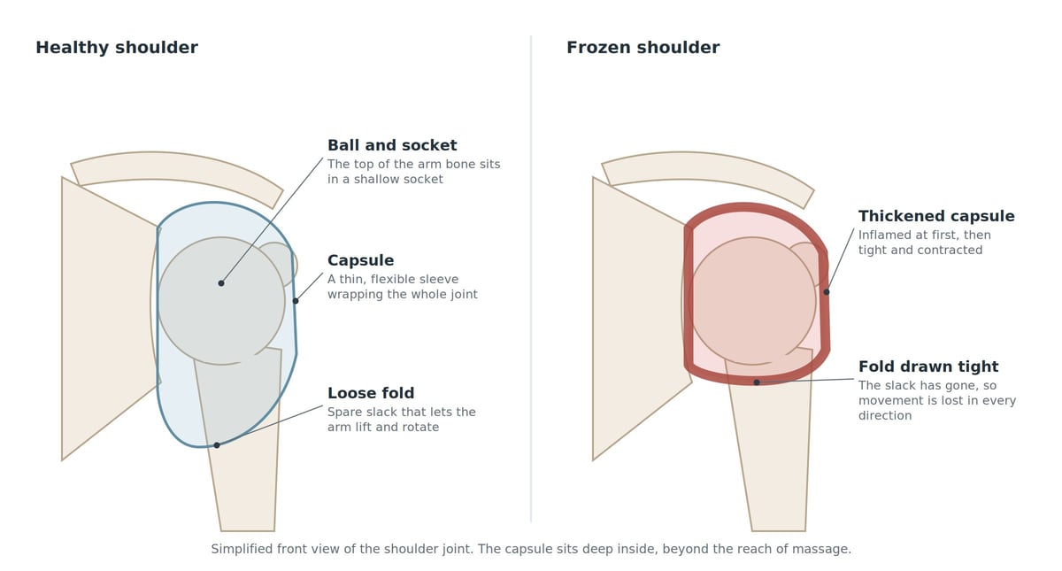 Anatomical diagram comparing a healthy and a frozen shoulder, showing the ball and socket joint, capsule, loose fold and thickened capsule