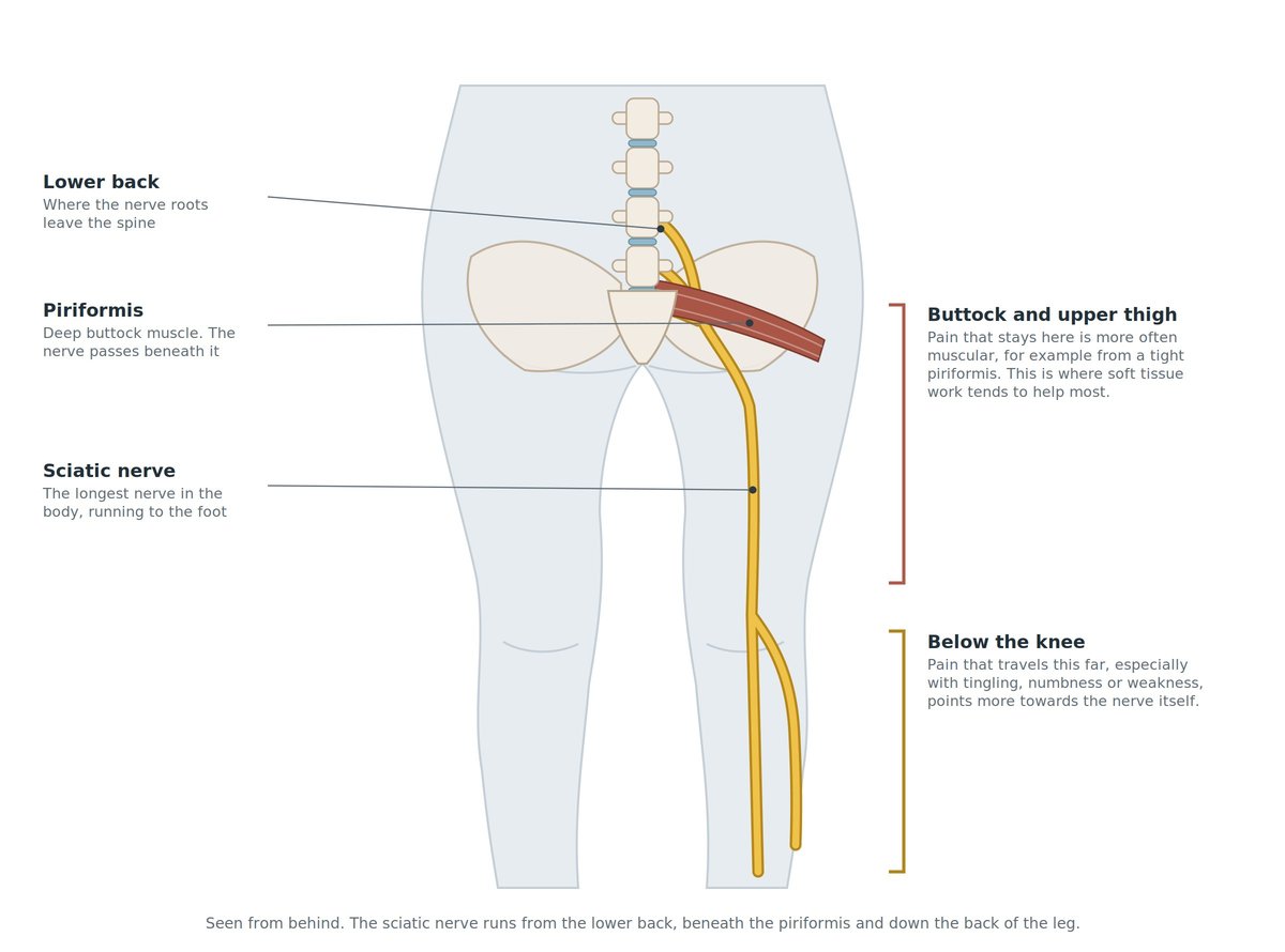 Anatomical diagram of sciatica showing lower back, piriformis muscle, sciatic nerve, and leg anatomy with labelled pain areas